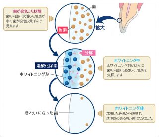 ホワイトニングのメカニズム